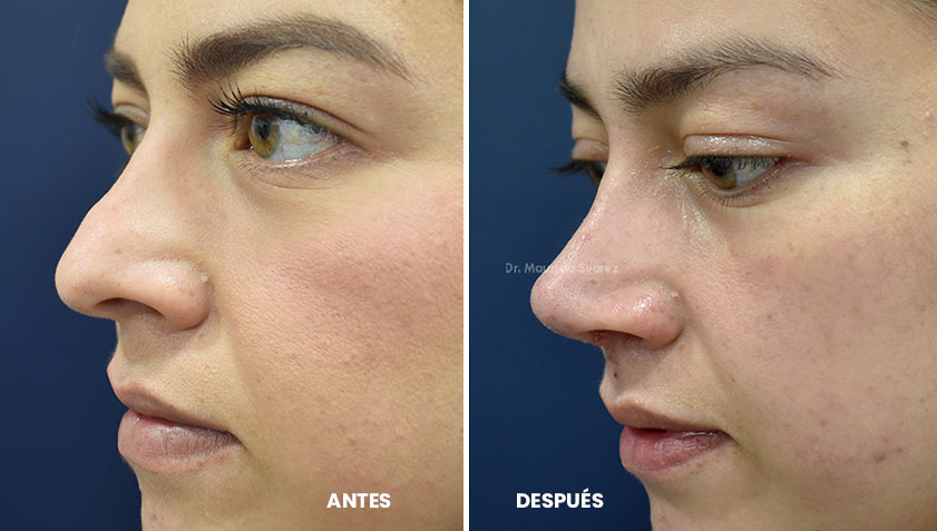  Cómo cambia la nariz después de una Rinoplastia Ultrasónica?